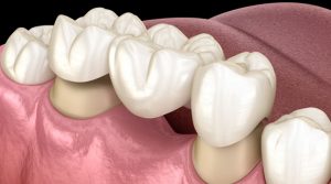 Illustration of how dental bridges work at our Alvarado Family Dental Office.