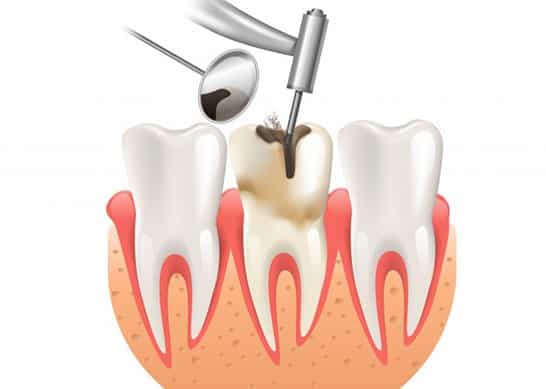 illustration of a root canal procedure at our dentistry in Alvarado, TX