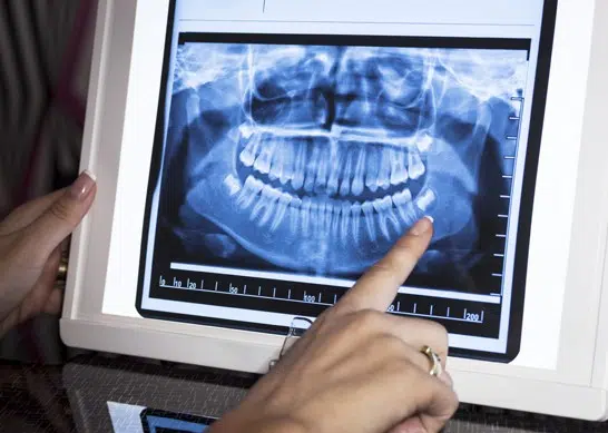 What Happens When Dental X Rays Are Taken