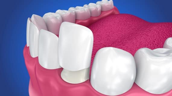 What Is A Dental Crown