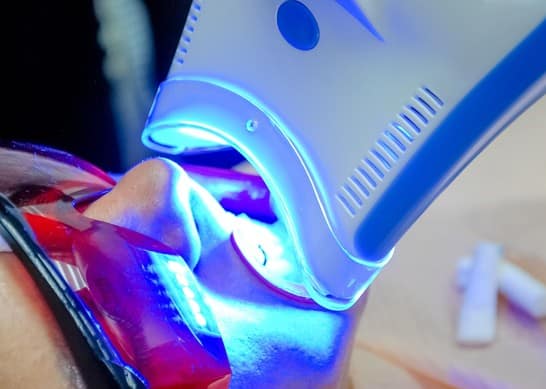Process For Professional Teeth Whitening at our cosmetic dentistry in Alvarado