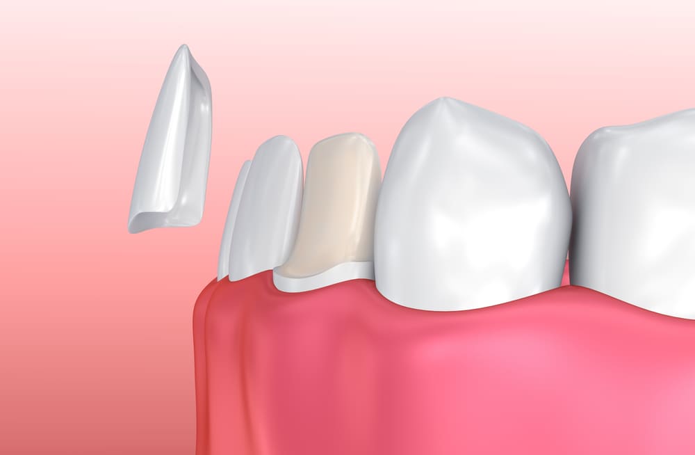 porcelain veneers in alvarado tx