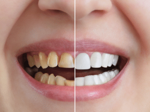 Patient showing off same day dental crowns