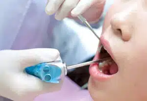 A Patient getting dental fillings at Lifeway Dental in Alvarado, TX